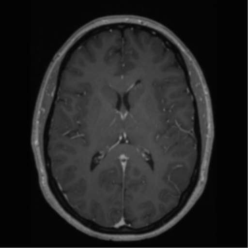Cerebral cavernoma and development venous anomaly (Radiopaedia 37603-39482 Axial T1 C+ 42).png