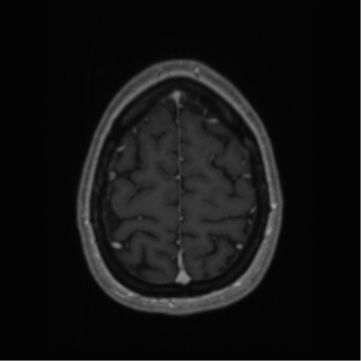 Cerebral cavernoma and development venous anomaly (Radiopaedia 37603-39482 Axial T1 C+ 65).png