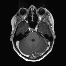 Cerebral cavernous venous malformation (Radiopaedia 70008-80021 Axial T1 C+ 19).jpg