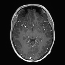 Cerebral cavernous venous malformation (Radiopaedia 70008-80021 Axial T1 C+ 31).jpg
