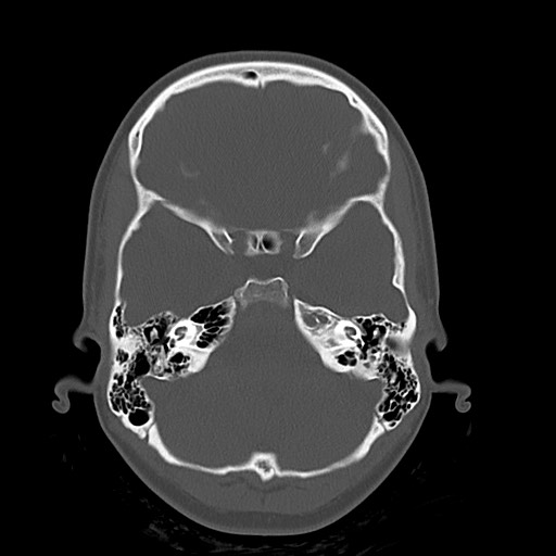 Cerebral cavernous venous malformation (Radiopaedia 70008-80022 Axial bone window 10).jpg