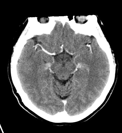 File:Cerebral cavernous venous malformations (Radiopaedia 48117-52945 Axial C+ delayed 15).png