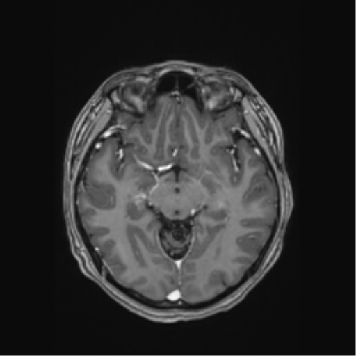 Cerebral cavernous venous malformations (Radiopaedia 48117-52946 Axial T1 C+ 24).png