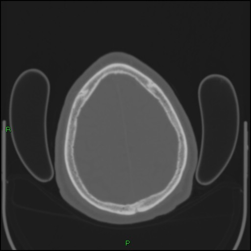 Cerebral contusions (Radiopaedia 33868-35039 Axial bone window 185).jpg