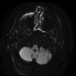 Cerebral embolic infarcts (embolic shower) (Radiopaedia 49837-55108 Axial DWI 89).jpg