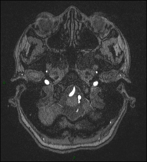 Cerebral fat embolism (Radiopaedia 35022-36525 Axial TOF 20).jpg