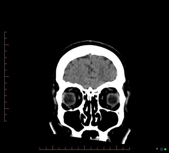 Cerebral fat embolism (Radiopaedia 85521-101220 Coronal non-contrast 12).jpg