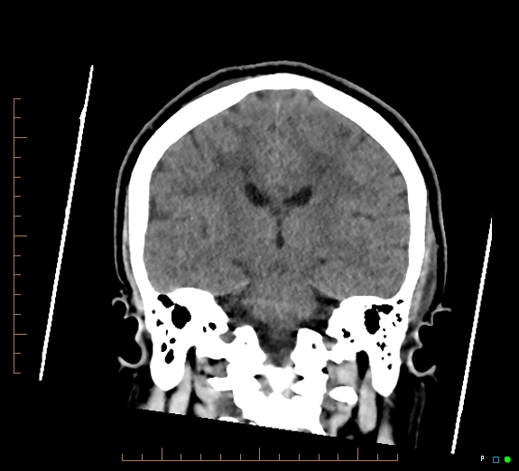 Cerebral fat embolism (Radiopaedia 85521-101220 Coronal non-contrast 37).jpg
