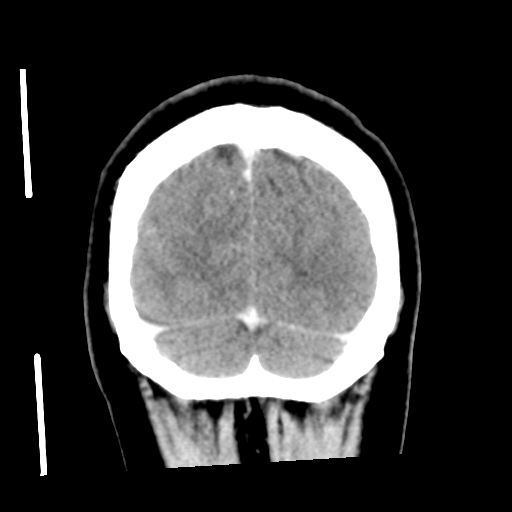 Cerebral hemorrhage secondary to arteriovenous malformation (Radiopaedia 33497-34561 C 58).png