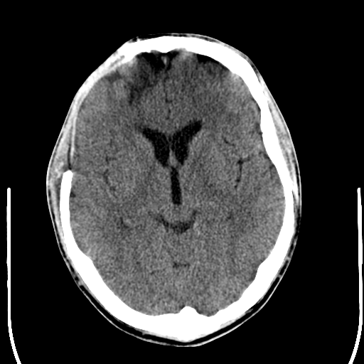 File:Cerebral hemorrhagic contusions- temporal evolution (Radiopaedia 40224-42756 Axial non-contrast 12).png