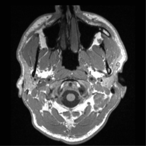 File:Cerebral hemorrhagic contusions- temporal evolution (Radiopaedia 40224-42757 Axial T1 4).png