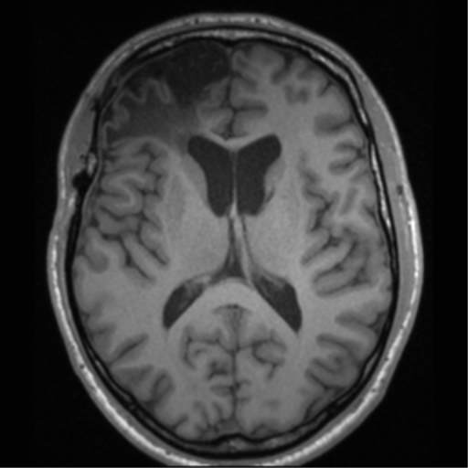 Cerebral hemorrhagic contusions- temporal evolution (Radiopaedia 40224-42757 Axial T1 42).png