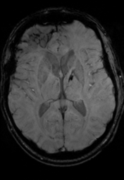 File:Cerebral hemorrhagic contusions- temporal evolution (Radiopaedia 40224-42757 D 20).png