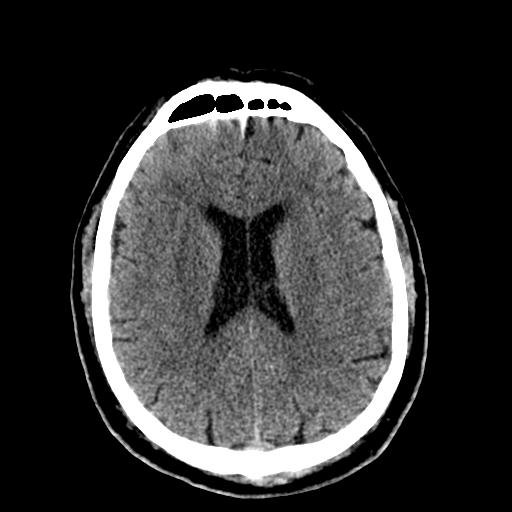 File:Cerebral hemorrhagic contusions and cervical spine fractures (Radiopaedia 32865-33841 Axial non-contrast 22).jpg