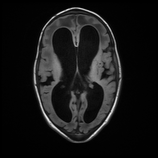 File:Cerebral manifestations of mucopolysaccharidosis type I (Radiopaedia 59171-66487 C 11).jpg