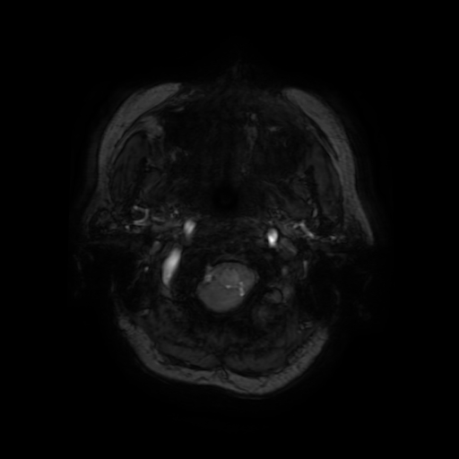 Cerebral metastases - melanoma (Radiopaedia 80972-94522 Axial SWI 6).jpg