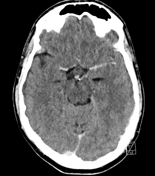 Cerebral metastases - testicular choriocarcinoma (Radiopaedia 84486-99855 Axial C+ delayed 35).jpg