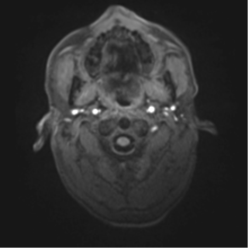 Cerebral metastasis - melanoma (Radiopaedia 54718-60954 Axial T1 1).png