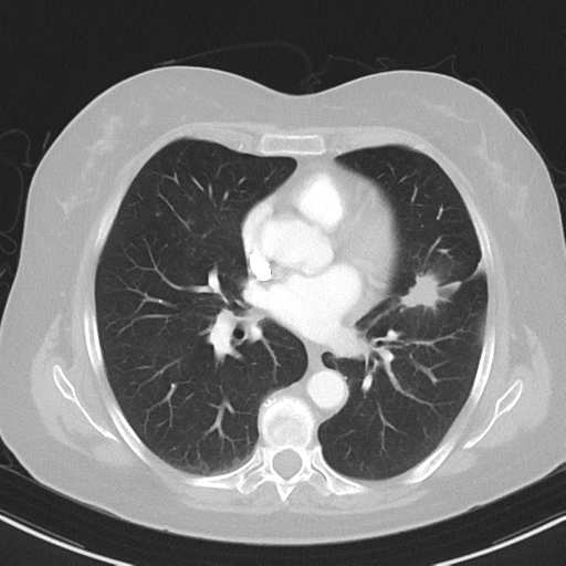 File:Cerebral metastasis mimicking glioblastoma (Radiopaedia 69155-78938 Axial lung window 25).png
