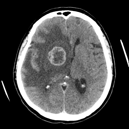 File:Cerebral metastasis to basal ganglia (Radiopaedia 81568-95412 Axial C+ delayed 31).png