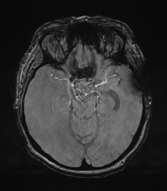 Cerebral metastasis to basal ganglia (Radiopaedia 81568-95413 Axial SWI magnitude 31).png