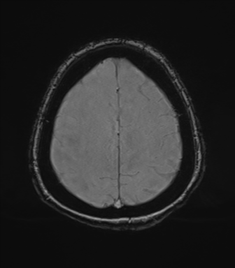 Cerebral metastasis to basal ganglia (Radiopaedia 81568-95413 Axial SWI magnitude 72).png