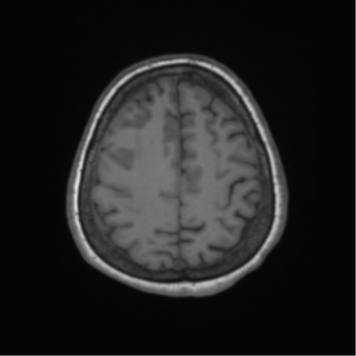 Cerebral metastasis to basal ganglia (Radiopaedia 81568-95413 Axial T1 58).png