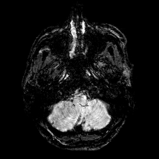 Cerebral parenchymal arteriovenous malformation (Radiopaedia 27280-27456 Axial SWI 2).jpg