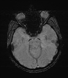 File:Cerebral toxoplasmosis (Radiopaedia 43956-47461 Axial SWI 14).jpg