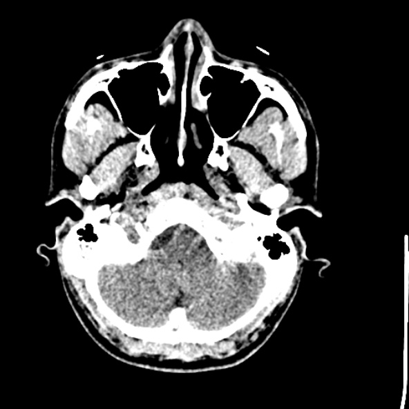 Cerebral toxoplasmosis (Radiopaedia 53993-60131 Axial non-contrast 13).jpg