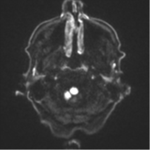 File:Cerebral toxoplasmosis (Radiopaedia 54575-60804 Axial DWI 37).png