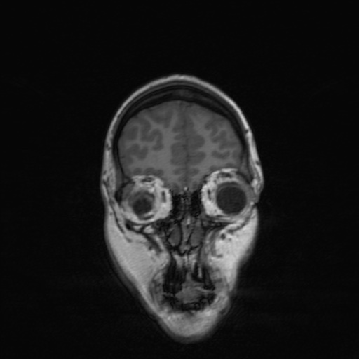 Cerebral tuberculosis with dural sinus invasion (Radiopaedia 60353-68090 Coronal T1 36).jpg