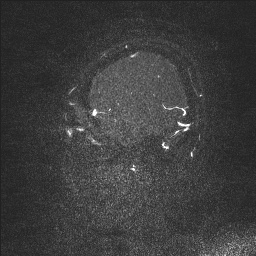 Cerebral tuberculosis with dural sinus invasion (Radiopaedia 60353-68090 Sagittal MRV 10).jpg