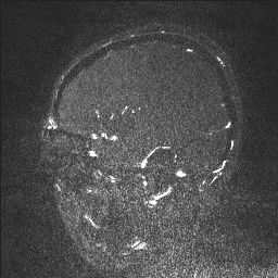 Cerebral tuberculosis with dural sinus invasion (Radiopaedia 60353-68090 Sagittal MRV 32).jpg