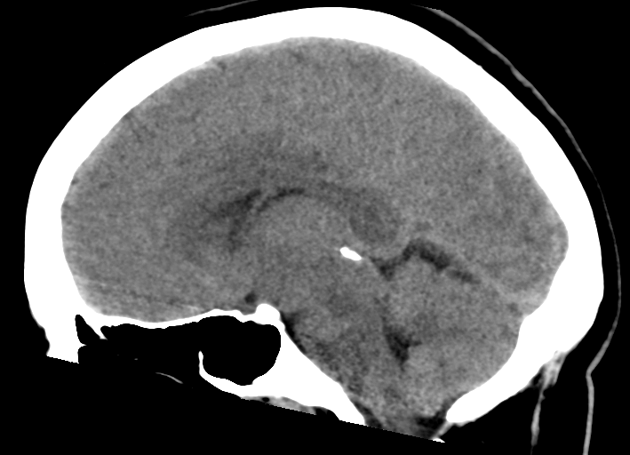 File:Cerebral venous infarct related to dural venous sinus thromboses (Radiopaedia 35292-36803 Sagittal 15).png