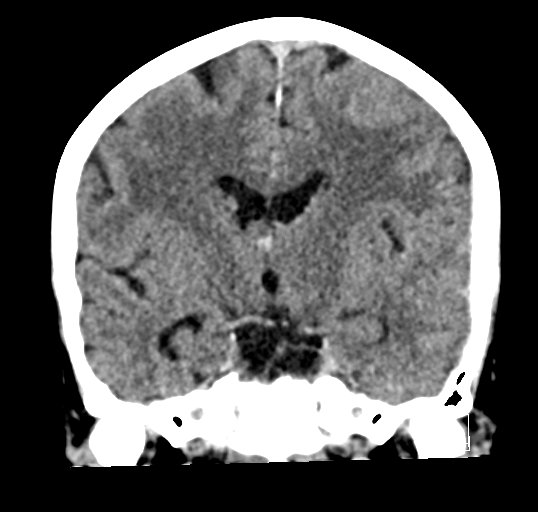 Cerebral venous infarction with hemorrhage (Radiopaedia 65343-74381 Coronal non-contrast 26).jpg