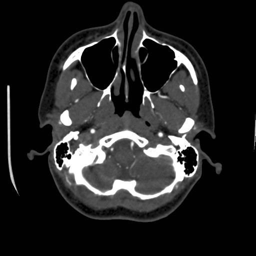 Cerebral venous sinus thrombosis (Radiopaedia 40619-43227 A 28).jpg