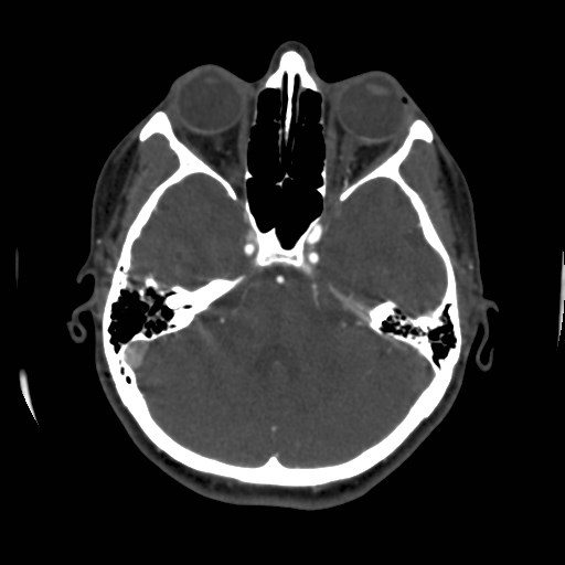 Cerebral venous sinus thrombosis (Radiopaedia 40619-43227 A 66).jpg