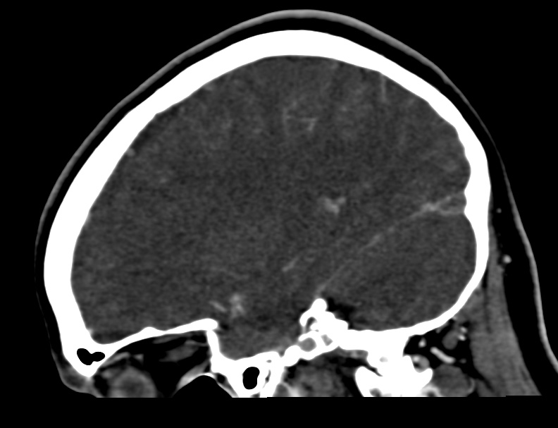 Cerebral venous sinus thrombosis (Radiopaedia 59224-66646 Sagittal C+ delayed 42).jpg