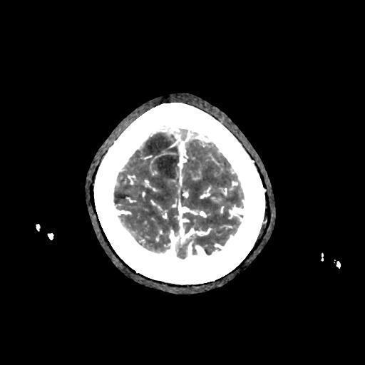 File:Cerebral venous throbmosis - hemorrhagic venous infarction (Radiopaedia 87318-103613 B 37).jpg