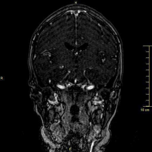 Cerebral venous thrombosis (Radiopaedia 23288-23351 MRV 75).JPG