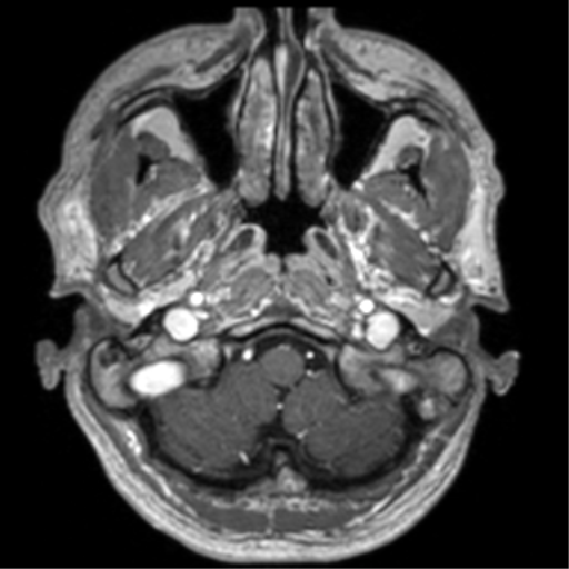 Cerebral venous thrombosis (Radiopaedia 38392-40469 Axial T1 C+ 12).png