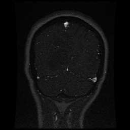 Cerebral venous thrombosis - ulcerative colitis (Radiopaedia 66049-75219 Coronal MRV 26).jpg