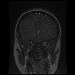 Cerebral venous thrombosis - ulcerative colitis (Radiopaedia 66049-75219 Coronal MRV 85).jpg