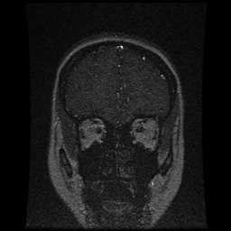 Cerebral venous thrombosis - ulcerative colitis (Radiopaedia 66049-75219 Coronal MRV 94).jpg