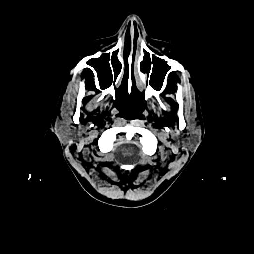Cerebral venous thrombosis with venous hemorrhagic infarct (Radiopaedia 90354-107660 Axial non-contrast 2).jpg