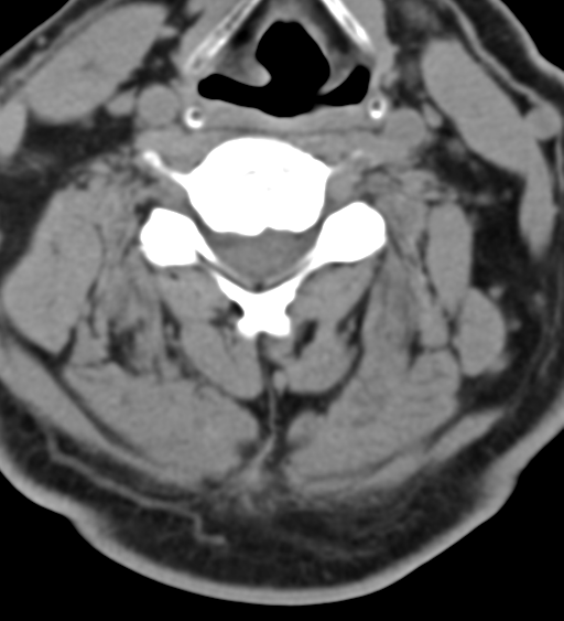 File:Cervical canal stenosis due to ossification of the posterior longitudinal ligament (Radiopaedia 47260-51823 Axial non-contrast 33).png