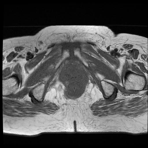 File:Cervical carcinoma (Radiopaedia 70924-81132 Axial T1 18).jpg