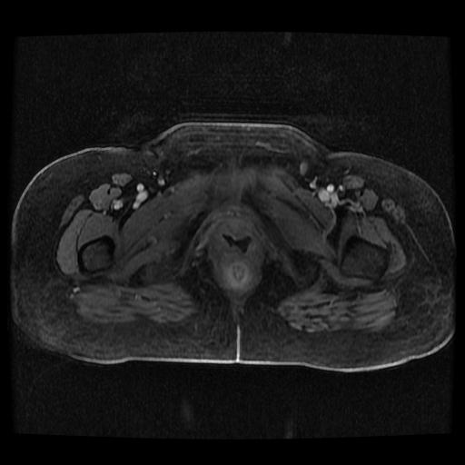 Cervical carcinoma (Radiopaedia 70924-81132 Axial T1 C+ fat sat 111).jpg