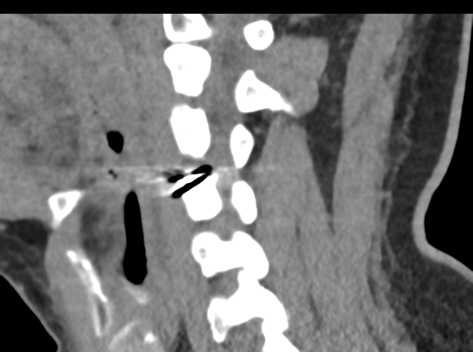 File:Cervical disc replacement (Radiopaedia 44025-47541 B 58).png